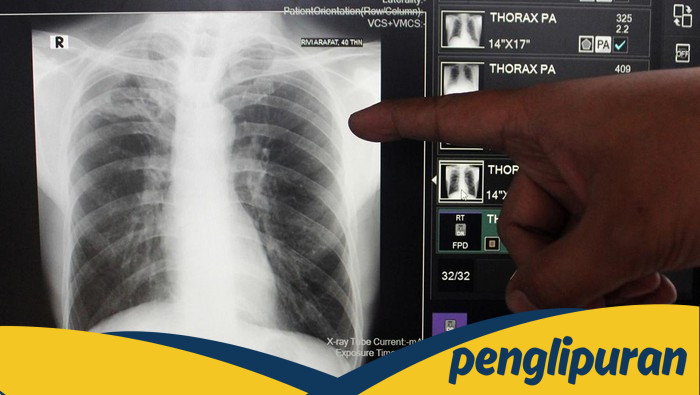 1 Juta Kasus TBC di Indonesia, Kenapa Masih Berlangsung?