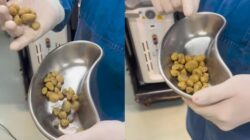 Minum Soda Berlebihan: Penyebab 35 Batu Ginjal di Tubuh Pasien, Cerita Dokter yang Wajib Diketahui!
