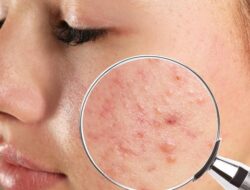 **Waspada! Dokter Harvard Ungkap Bentuk Jerawat Ini Bisa Jadi Tanda Kanker Kulit**