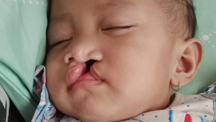 Balita Khalisa Butuh Perjuangan 3 tahap, Yuk Perhatikan!