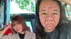 Viral Bumil Wajahnya Berubah Drastis saat Hamil, Ternyata Ini Penyebabnya – Update 1