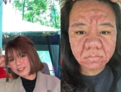 Viral Bumil Wajahnya Berubah Drastis saat Hamil, Ternyata Ini Penyebabnya – Update 1