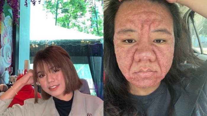 Viral Bumil Wajahnya Berubah Drastis saat Hamil, Ternyata Ini Penyebabnya - Update 1