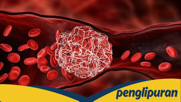7 Tanda Membeku Darah yang Sering Diabaikan, Bisa Jadi Penyebab Stroke dan Serangan Jantung!