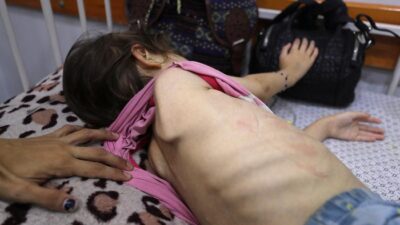 Anak di Gaza Hadapi Malnutrisi, Ini Dampaknya pada Tubuh saat Kelaparan