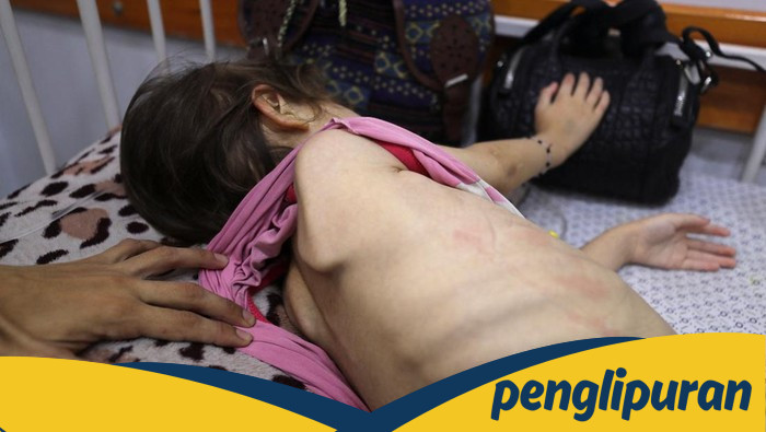 Anak di Gaza Hadapi Malnutrisi, Ini Dampaknya pada Tubuh saat Kelaparan