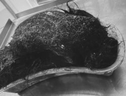 Gumpalan Rambut Raksasa Ditemukan di Perut Bocah 14 Tahun, Dokter: Ini Penyebabnya!