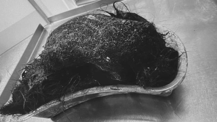 Gumpalan Rambut Raksasa Ditemukan di Perut Bocah 14 Tahun, Dokter: Ini Penyebabnya!