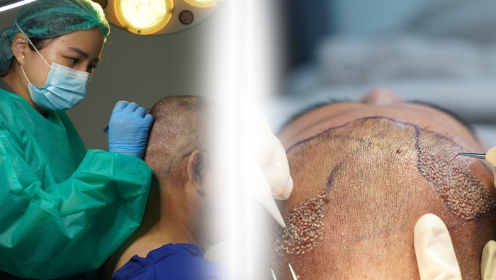 Apakah Transplantasi Rambut Diperbolehkan dalam Islam? Mengetahui Hukumnya