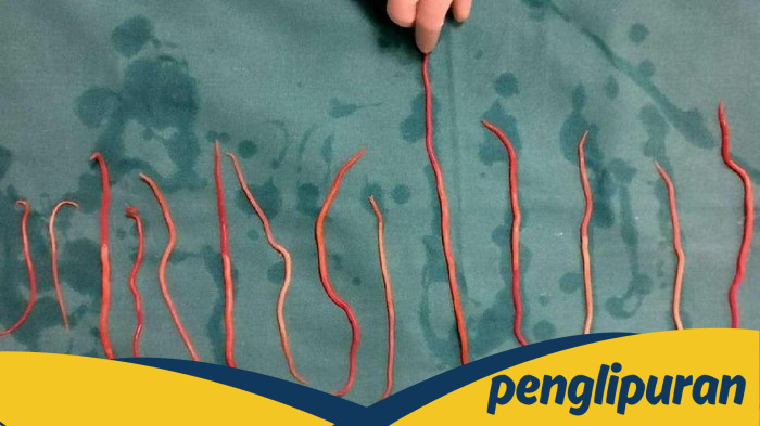 [Balita Sukabumi Meninggal dengan Tubuh Dipenuhi Cacing, RSUD Ungkap Kondisinya]