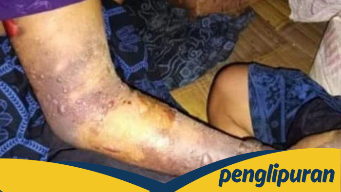 Dinkes Lebak Janji Segera Sediakan Serum Anti Bisa Ular untuk Warga Baduy, Solusi bagi Warga yang Rentan Ular Berbisa?