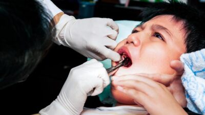 “90% Anak Terkena Karies Gigi! Apa yang Dilakukan IDGAI?”