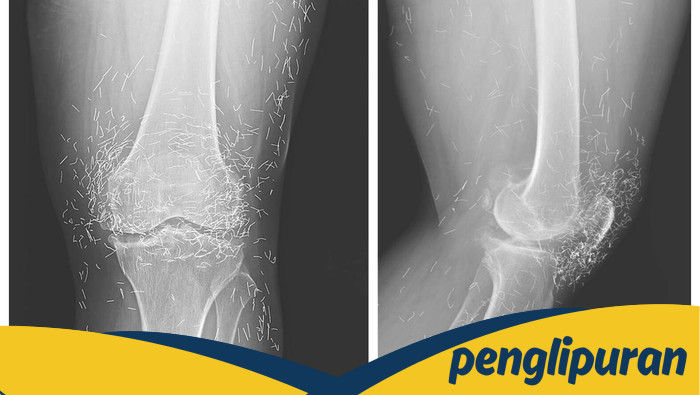**Penampakan Ratusan Benang 'Susuk' Emas di Tubuh Pasien, Masuk Lewat Mana?**