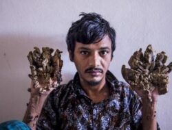 Pria Ini Kena Penyakit Langka, Tangan dan Kakinya Bak Kulit Kayu! Ini Respon Medisnya
