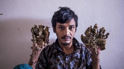 Pria Ini Kena Penyakit Langka, Tangan dan Kakinya Bak Kulit Kayu! Ini Respon Medisnya