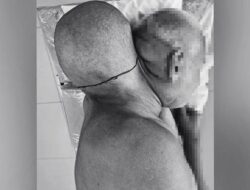 Cerita Pria Punya Tumor Raksasa Sebesar Kepala, Tolak ke RS Selama 16 Tahun: Pelajaran Berharga Tentang Pentingnya Perawatan Medis