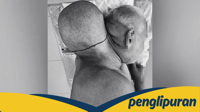Cerita Pria Punya Tumor Raksasa Sebesar Kepala, Tolak ke RS Selama 16 Tahun: Pelajaran Berharga Tentang Pentingnya Perawatan Medis
