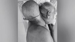 Tumor Sebesar Kepala Mengejutkan Pria 65 Tahun, Apakah Ini Pertanda?