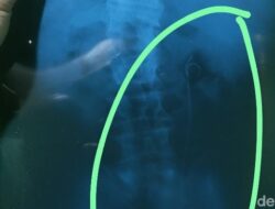 RSUD Batang Jelaskan soal Heboh Selang Tertinggal di Tubuh Pasien Usai Operasi: Fakta Mengejutkan Terungkap!