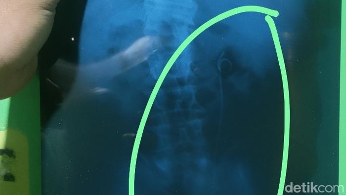 RSUD Batang Jelaskan soal Heboh Selang Tertinggal di Tubuh Pasien Usai Operasi: Fakta Mengejutkan Terungkap!