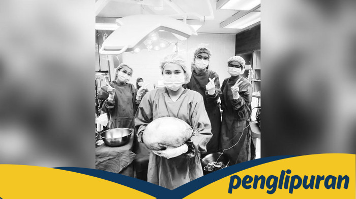 Dikira Buncit, Ternyata Ada Kista Seberat 8 Kg Bersarang di Perut Wanita Ini: Insight Kesehatan yang Perlu Diketahui