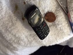 “Momen Dokter Keluarkan Ponsel dari Lambung Pasien, Begini Penampakannya”