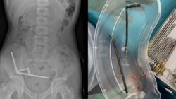 Ngilu! 100 Magnet Ditemukan di Usus Remaja, Dokter Terkejut!