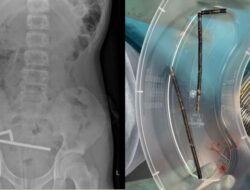 Ngilu! 100 Magnet Ditemukan di Usus Remaja, Dokter Terkejut!