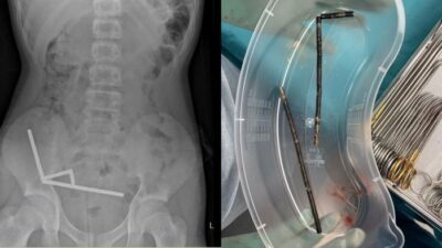 Ngilu! 100 Magnet Ditemukan di Usus Remaja, Dokter Terkejut!