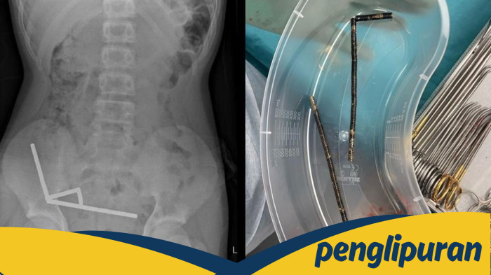 Ngilu! 100 Magnet Ditemukan di Usus Remaja, Dokter Terkejut!