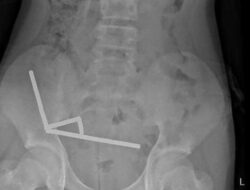 **Keselamatan Anak dari Magnet Berbahaya: Kasus 13 Tahun yang Mengalami Operasi Usus**