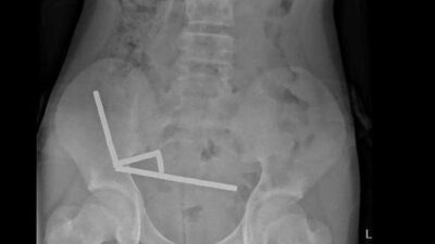 **Keselamatan Anak dari Magnet Berbahaya: Kasus 13 Tahun yang Mengalami Operasi Usus**