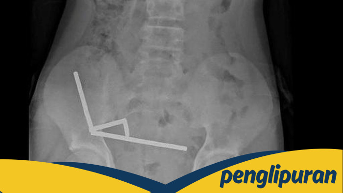 **Keselamatan Anak dari Magnet Berbahaya: Kasus 13 Tahun yang Mengalami Operasi Usus**