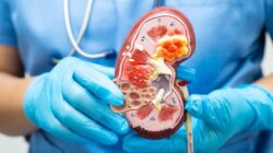 **Perubahan Warna Urine yang Menandakan Gagal Ginjal dan Pentingnya Deteksi Dini**