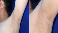 Wanita Ini Alami Kondisi Langka: ASI Keluar dari Ketiak, Ketahui Faktanya!