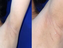 Wanita Ini Alami Kondisi Langka: ASI Keluar dari Ketiak, Ketahui Faktanya!