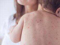 [Kanada Kehilangan Status Bebas Campak dengan 5 Ribu Kasus Baru!]