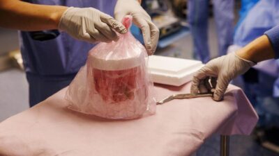 Peneliti AS Semakin Dekat Wujudkan Transplantasi Ginjal Babi untuk Manusia – Update 1