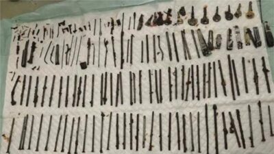 [Ngilu! Dokter Temukan 120 Benda Asing di Perut Pasien, Ada Pisau-Gunting]