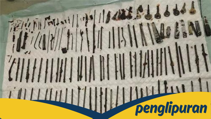 [Ngilu! Dokter Temukan 120 Benda Asing di Perut Pasien, Ada Pisau-Gunting]